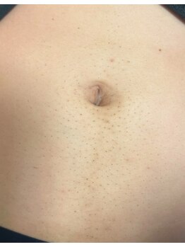 ルボーテ(Re beaute)/メンズ脱毛2回目