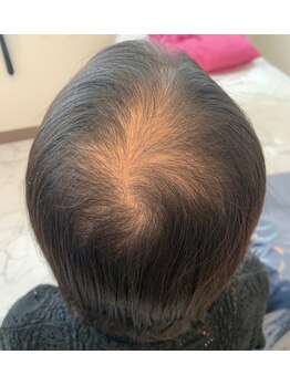 アブソリュートワン(absolute1)/頭髪育毛促進☆エクソソーム