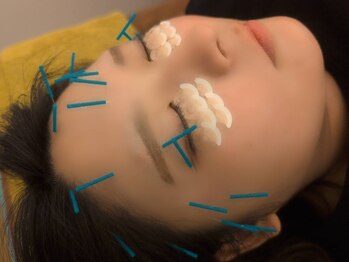 はしもと鍼灸整骨院/お目目ぱっちり目元重点美容鍼灸