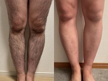 リーベ(Liebe×RNJ)/ムダ毛レスな足をゲット