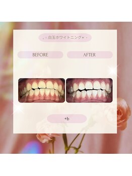プラスビー 2号店(+b)/ホワイトニングビフォーアフター