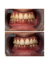 アデル 久留米(ADEL)/ホワイトニング(歯医者提携)