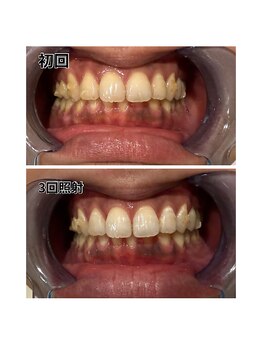 アデル 久留米(ADEL)/ホワイトニング(歯医者提携)