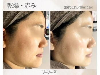 スリースリー(THREE THREE)/乾燥・赤みケア