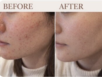 ルージュ(CP Rouge)/30代女性/ダブル毛穴洗浄6回