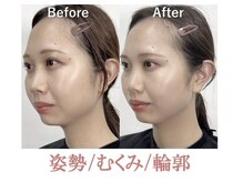 ラプリシュシュ 岡山店(Raplit)/ 隆鼻＋輪郭矯正40分10回