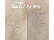 ディオーネ 吉祥寺駅前店(Dione)/両脇１０回美ブリッド脱毛♪