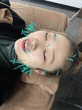 きらめき鍼灸治療院/美容鍼が選ばれる理由