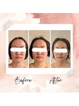 プレジール(Plaisir)/コルギ＆筋膜リリース＆EMS　3回