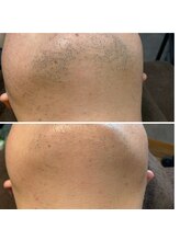 ティエル(TieLu)/ヒゲ脱毛