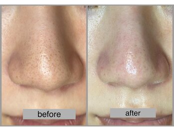 ブリノス(BLINOSS)/毛穴エクストラクション