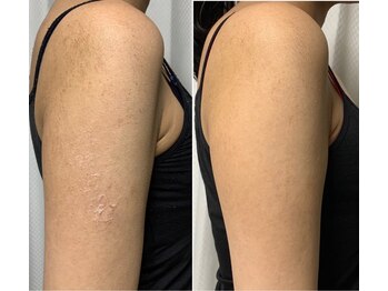 リベル 名古屋(Lebelle:)/ハーブピーリング専門名古屋