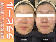 ブレア(Blair)/ララピール