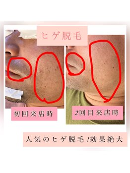 ティアメディカル(Tia Medical)/ヒゲ脱毛