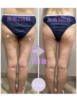 アン(Anne)/【術後ケア】インディバボディ