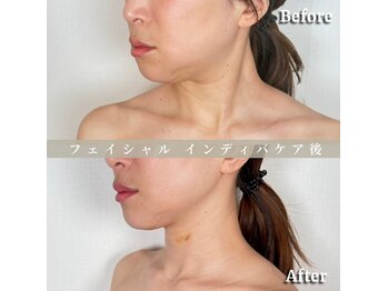 術後の女神 大阪本町店/ダウンタイムケア・インディバ