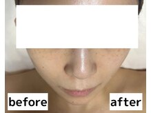 小顔専門店Lift(リフト)下北沢/小顔専門店Lift｜Before After