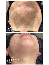 クラスペディア 嘉島店/髭脱毛♪抜ける♪効果満足◎