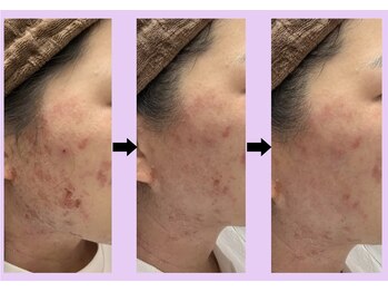 エヌフェイシャル(N.facial)/極度の肌荒れ