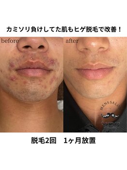 イエス 久留米店(YES)/ヒゲ脱毛ビフォーアフター