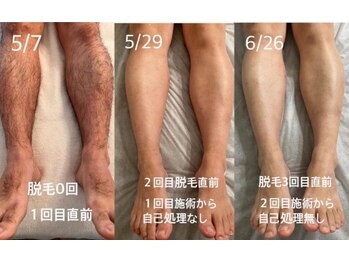 ルーチェ/【ひざ下脱毛】短パンが似合う脚