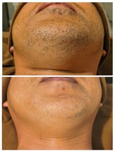 ボンダイボディー(Bondi Body)/メンズ髭脱毛