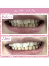 エクシアホワイトニング 天王寺店/ホワイトニングビフォーアフター