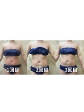 介正鍼灸整骨院 整体院 エフコープ大野城店/痩身エステ＊ラジオ波／キャビ