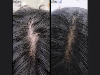 キュライム 熊本(CURAIM)/育毛促進【40代女性】