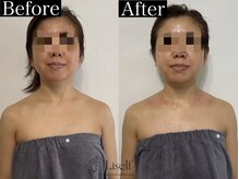 リセルフ(Liself)/肌改善120分コースでご褒美ケア