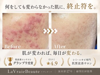 ラヴレボーテ(La Vraie Beaute)の写真/◆岸和田・久米田◆繰り返す肌悩みに終止符を。顧問医師提携で、魅せる素肌へ導く本気の肌改善◆