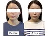 【圧倒的な小顔人気No.1】骨格美人へ 美容鍼×小顔矯正スペシャル ★60分