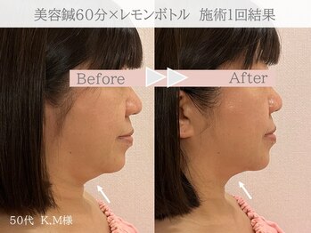 ネテマテ 表参道(netemate)/美容鍼×レモンボトル