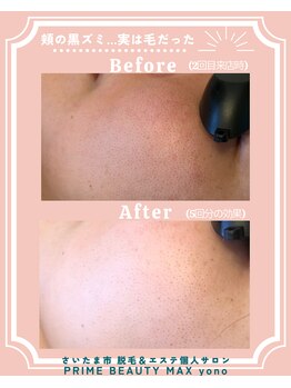 マックス 与野店(MAX)/最新顔脱毛☆ビフォアフ /うなじ