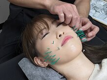 京美/施術風景【極美容鍼+小顔整体】