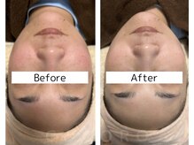 ココロ(COCORO)/プラズマで赤み/くすみ/シミケア