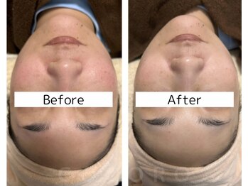 ココロ(COCORO)/プラズマで赤み/くすみ/シミケア