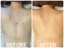 ハーブピーリング横浜の雰囲気（全身ケア可能なハーブピーリングで背中やヒップも人気◎）