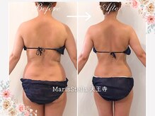 マリスステラ 天王寺(MarisStella)/上半身痩せ【天王寺エステ】