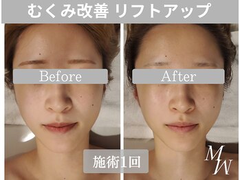 ミピマム 町田店/写真映えする小顔へ