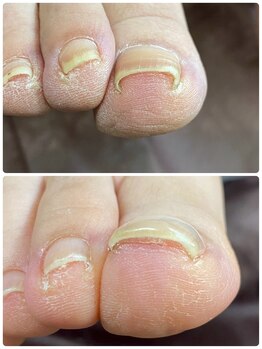 ネイル キシミー(Nail-Kishimi)/巻いて痛い爪をまかなくする！