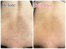 エミルカ 北谷店(EMILUCA)/黒ずみ