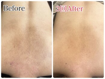 エミルカ 北谷店(EMILUCA)/黒ずみ