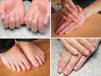 モーダアッカ(moda acca)の写真/《烏丸/四条》巻き爪・深爪が気になる方へ！爪の形を整え、お悩みを改善します♪クーポン多数ご用意☆