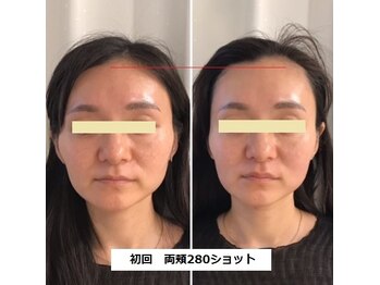ナチュレアンドメディカ(Nature&Medica)/【たるみ&小顔】ソフウェーブLT