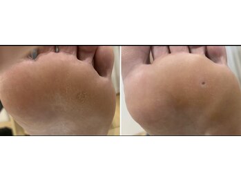 足裏角質のケアのオプション