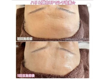 エクレット/【ハリ弾力UP】お客様の変化