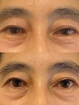 ビーアイリー(Be irie)/フェイシャルエステ直後の変化