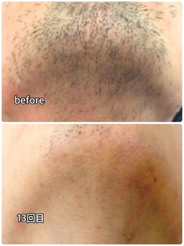 メンズガーデン 今池店/ヒゲ脱毛効果