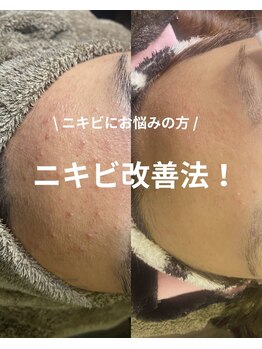 デン(DEN)/ニキビ改善ケア